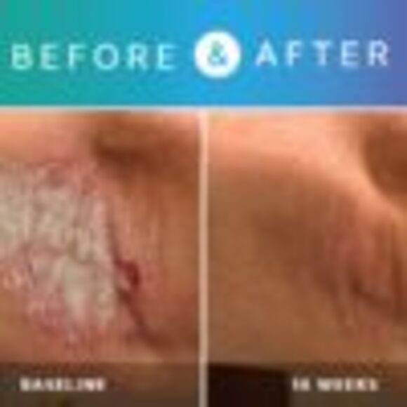 Psoriasis Treatment System Kit 1-Month Supply - Picture 3 of 3